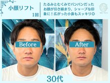 フローフシ∞/【小顔】切らない小顔リフト