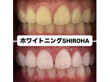 シロハ(SHIROHA)/セルフホワイトニング/天王寺