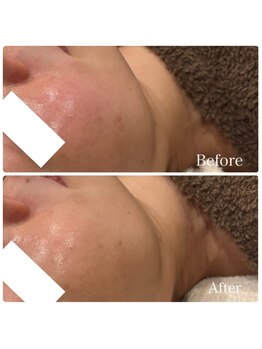 アキュレ(Acure)/