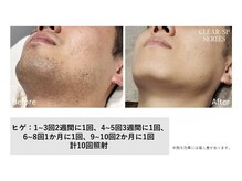 マイプラ(mypla)/メンズヒゲ