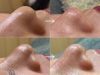 アルテ 神戸(Arte)の写真/【 人気急上昇 】いちご鼻撃退！頑固な毛穴の黒ずみ・ザラつきを徹底改善◎