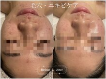 クレア(CLEA)/毛穴にもニキビにも ◎