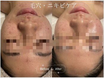 クレア(CLEA)/毛穴にもニキビにも ◎