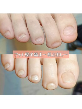 マニエネイル(mani e nail)/フットの深爪矯正(長さ出し)