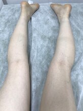 ナノハナ/鹿沼市本格全身脱毛ナノハナ