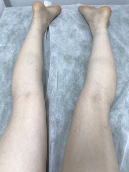 ナノハナ/鹿沼市本格全身脱毛ナノハナ