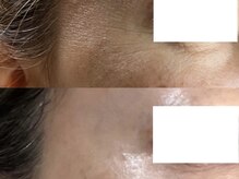 ミルジュ(MiLuJu)/ACトリートメント4回BeforeAfter