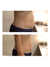 アクア エステティコ 亀有(ACQUA estetico)/痩身　部分ケア　腹部