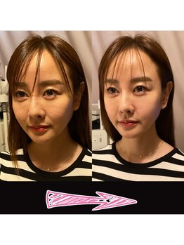 ネルジム 札幌店(NERU GYM)/1回の施術でこの効果！