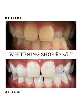 ホワイトニングショップ 新小岩店/どこよりも効果を実感☆