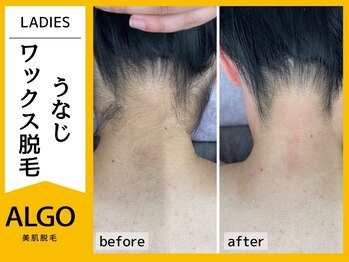 アルゴ 小松店(ALGO)/うなじワックス脱毛