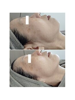 ビーユー(Be.you)/シミとたるみでお悩みの方