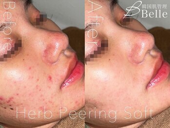 ベル 本八幡(Belle)/ハーブピーリング｜ニキビケア