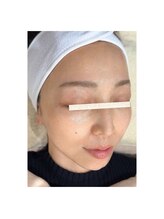 ビースキン(be-skin)/県内初導入マシンafterお写真♪