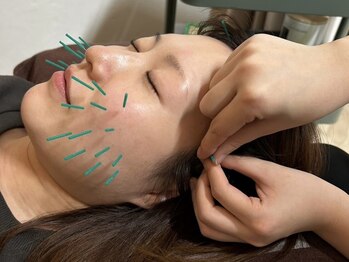 ゼロプラス(ZERO+)の写真/【美容鍼ですっぴん美人へ☆】エラ張り/たるみ/ほうれい線等、気になるお肌のトラブルに徹底アプローチ♪