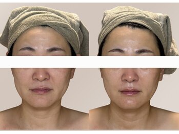 ユニ(Uni)/ほうれい線、こじわ薄く