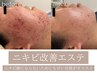 【ニキビ改善コース】ご新規様2・3回目専用クーポン/5週以内の再来限定♪