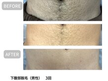 サロン ルーシュ(salon ruche)/脱毛(下腹部)