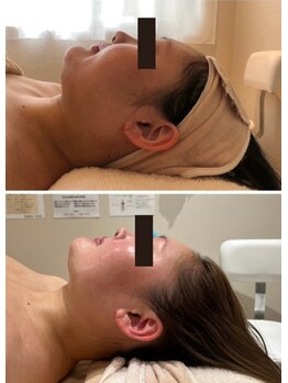 エイシスグロウ(asis glow.)/効果写真