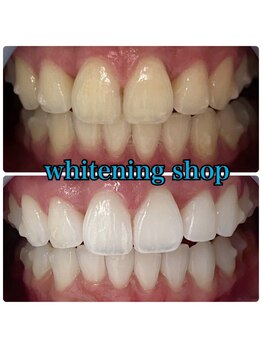 ホワイトニングショップ 倉敷店/