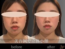 チョコバリ 郡山店(chocobari)/小顔×リフトアップ(美容鍼)20代