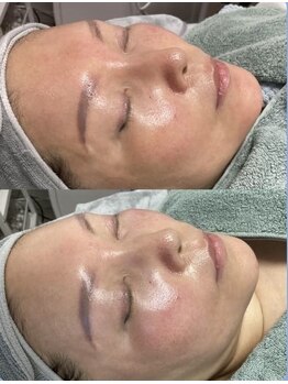 ホワイティアビシェル 浦和(Whitia Vishell)/ハイドラ毛穴レス+小顔リフト