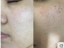 シミケアやり放題が￥5500で受けられる★