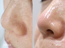 マイ フェア レディ(MY FAIR LADY)/毛穴・黒ずみ改善