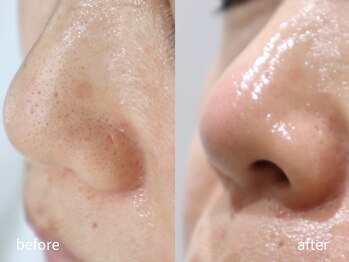 マイ フェア レディ(MY FAIR LADY)/毛穴・黒ずみ改善