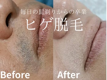 メイプル(Maple)の写真/もう、剃るストレスは終わり!ヒゲ無し生活始めませんか?