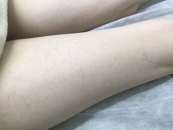 ナノハナ/鹿沼市本格全身脱毛ナノハナ