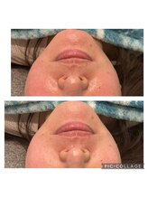 レイモード(Ray mode)/BBLフェイシャル＆パック