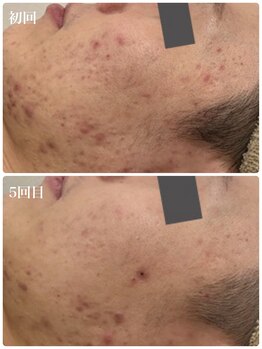 フルオール(FRUOR)/繰り返すニキビに◎学割あり