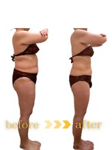 ウィッシュ(WISH)/セルライトゼロ全身コース