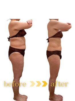 ウィッシュ(WISH)/セルライトゼロ全身コース