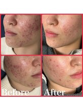 オルズ(Olu's)/ハーブピーリング｜ニキビケア