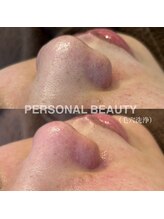 ピービー(PB)/ハイドラフェイシャル(毛穴洗浄)