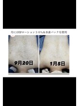 サロン キママ(Salon Kimama)/お背中もハーブピーリング♪