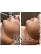 スプレール 水戸店/レモンボトルフェイシャル