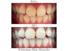 ホワイトニングショップ 静岡店/ホワイトニングBefore→After