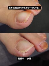 巻き爪じゅん 千葉駅前店/巻き爪と痛みに悩む方へ