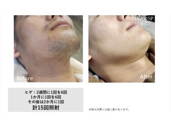 マイプラ(mypla)/メンズヒゲ