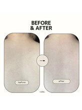 カルム(calm.)/背中脱毛