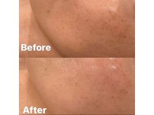 美容整骨小顔ラボ/肌【複合施術】ビフォーアフター