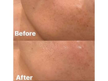 美容整骨小顔ラボ/肌【複合施術】ビフォーアフター