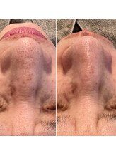 美肌研究所 東京新宿支店/毛穴改善、詰まり予防！