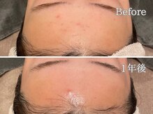 ポポラス(POPOLUS)/肌質改善コース　1年継続