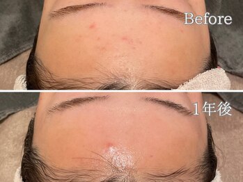 ポポラス(POPOLUS)/肌質改善コース　1年継続