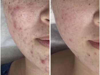 アンリミット 鹿児島天文館店(Une limit)/繰り返すニキビに