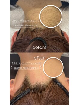 ミモザ(MIMOZA)/【えり足・うなじダブル脱毛】